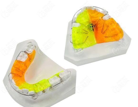 双颌垫功能性twinblock矫治器佩戴痛苦吗附带你们关心的价格