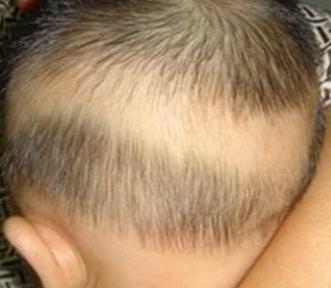 5,枕秃(钙圈)