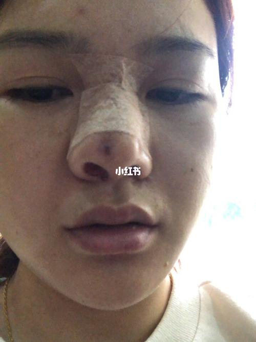 假体穿孔,鼻子感染溃17_隆鼻_硅胶_美妆_医美整形