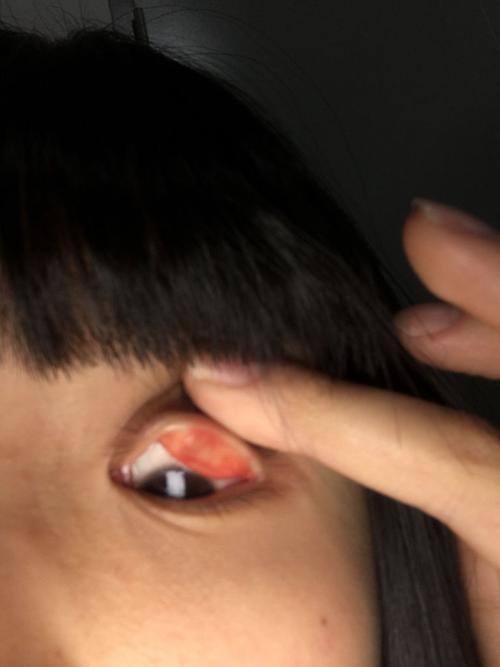 左眼皮里长了一个疙瘩,不痛不痒,长了三个月了,因为不