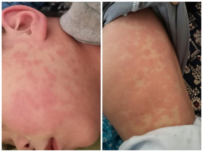 发热,皮疹……"红孩儿"要警惕这个病