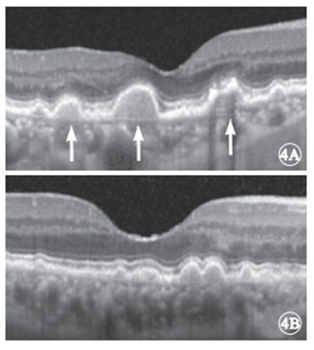 萎缩型老年性黄斑变性玻璃膜疣的频域光相干断层扫描图像特征