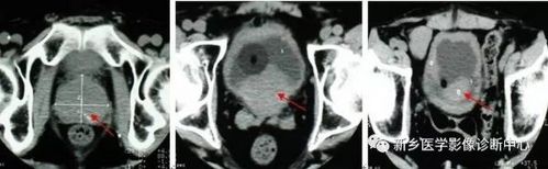 膀胱异常,应想到这18种膀胱病变!