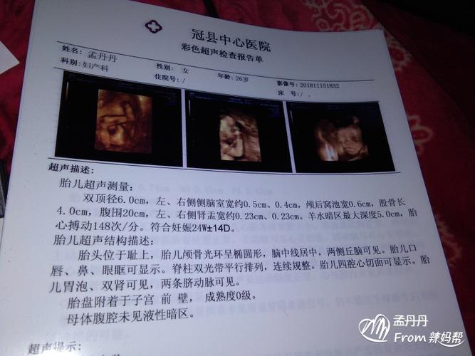 我怀孕5个多月,刚做的四维彩超,能不能帮我看看,胎儿的性别
