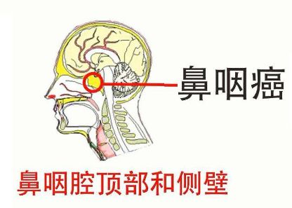 鼻出血是上火?33岁男性查出鼻咽癌,一些症状别当成鼻炎