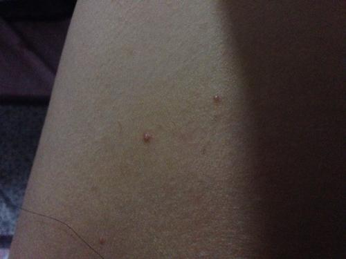 什么尖锐湿疣,扁平疣这