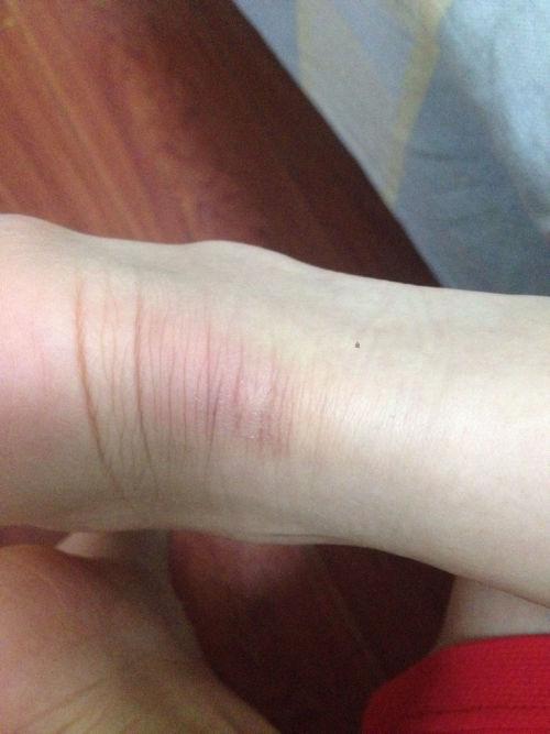 最近一段时间脚后跟莫名的疼脱了袜子发现局部红肿不