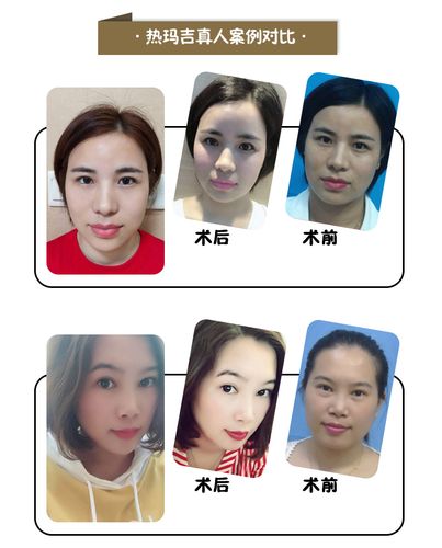 热玛吉紧致提升除皱抗衰450发加强版热玛吉黄金探头专人专头