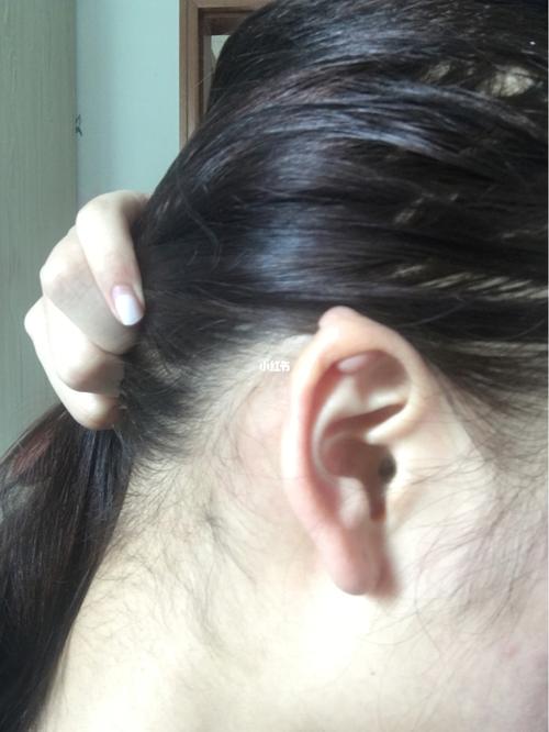 耳洞增生,建议大家不要轻易打耳洞了01_耳洞_疤痕_崇州市第二人民