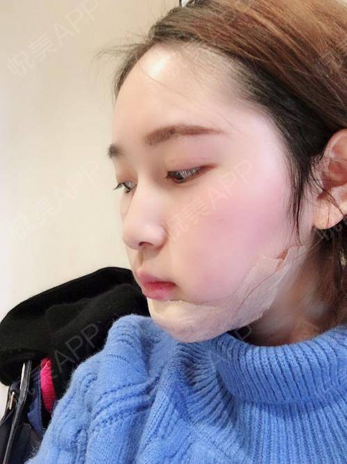 今天是我在上海薇琳做假体下巴第二天,还要好几天之后.