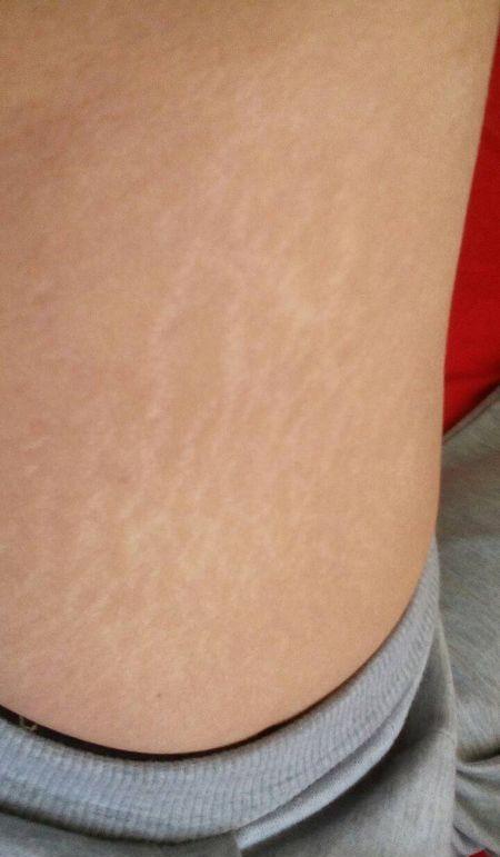 腿上的肥胖纹怎么去掉