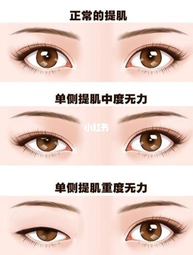 双眼皮手术_肌无力_单眼皮_双眼皮_上睑提肌无力_美妆_医美整形