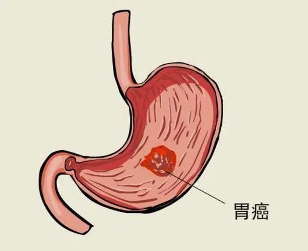 身体出现3个异常幽门螺杆菌已超标若一个没有胃部还算健康