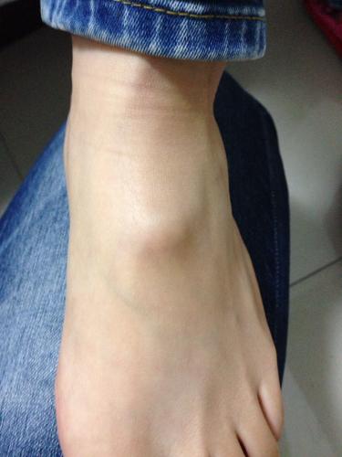 一般腱鞘囊肿是生长在手上或者脚背上的一种囊性肿物,键鞘囊肿的大小