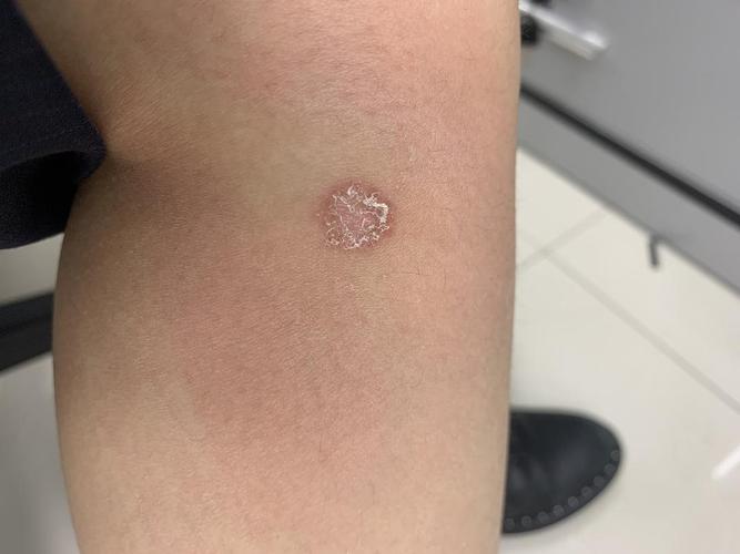 【讨论】人身上长猫藓了