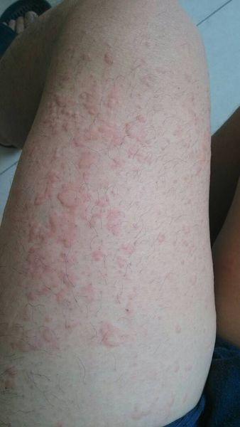 吃鱼又刺激过敏反应了?