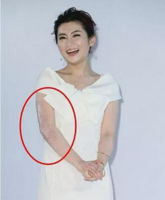 任家萱意外烧伤和未婚夫结婚不久张承中看见她大腿就想吐