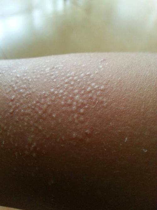 主治医师来自福建省福州市第二医院  投诉 答: 你说的是毛周角化症