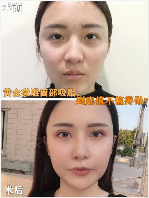 黄金微雕面部吸脂到底值不值得做