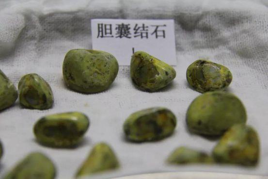 演员蔡明深夜进医院!关于胆结石,有这些习惯的人要小心了