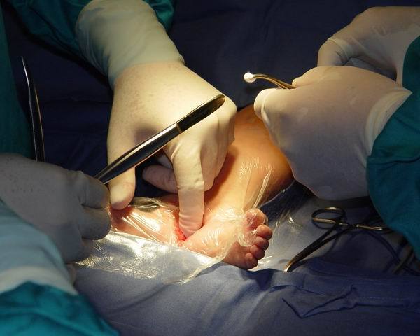 医学上将其称为"美人鱼综合症"