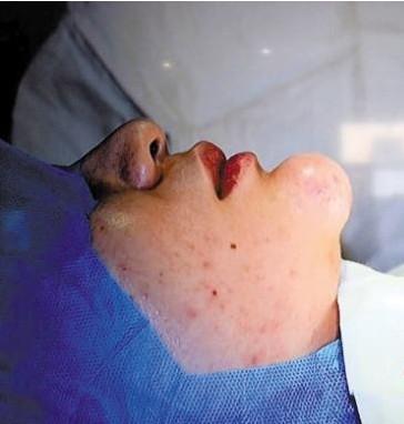 违规注射"细胞生长因子"女子隆下巴险毁容