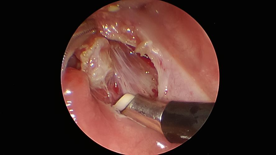 鼻咽喉部等离子射频消融术