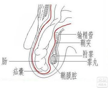 睾丸鞘膜积液的物理疗法有哪些
