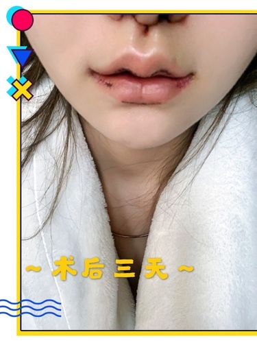 中缩短 唇综合30天～看到太多姐妹好奇人中的手术,_圈子-新氧美容整形