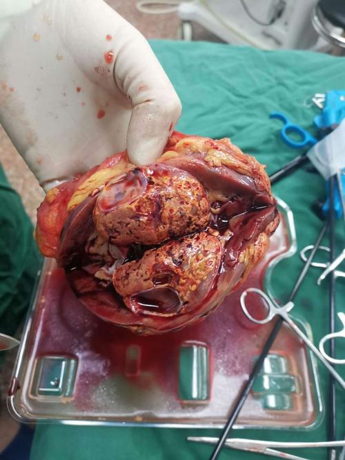 相比之下腹腔镜肾脏切除术仅在病人的腹部开通四个1到2厘米的小通道