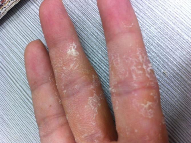 手癣图片是什么样的!
