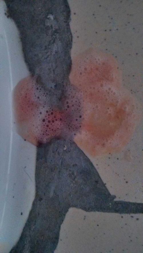 我这样有一段时间了,我怕自己得了什么病,他们说是肺结核,我都快吓死