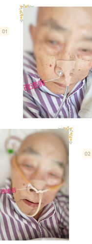 神经内科鼻饲管固定so easy