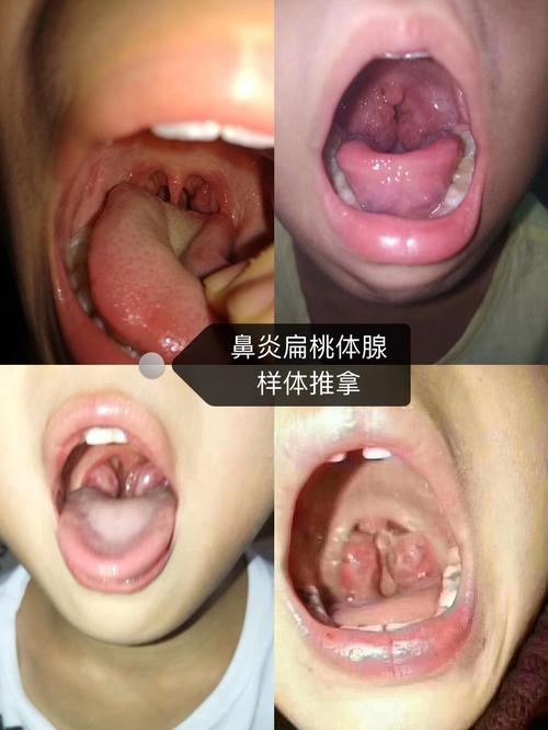 中班大班的小朋友,腺样体肥大扁桃体肿大