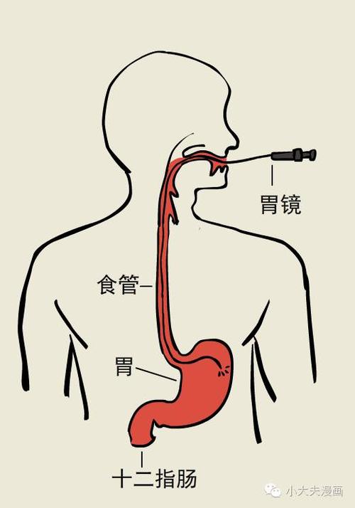 专家胃镜做还是不做