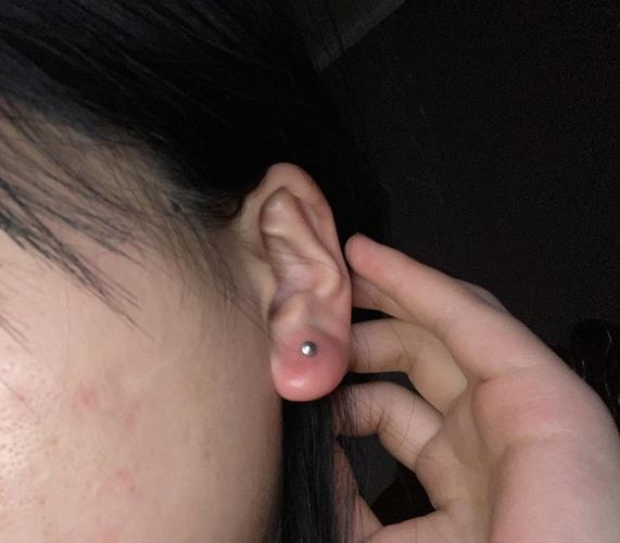 求助 打耳洞后耳朵肿了怎么办