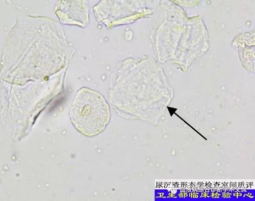 来源于肾盂,输尿管,膀胱和尿道近膀胱段等处,分为表层移行上皮细胞