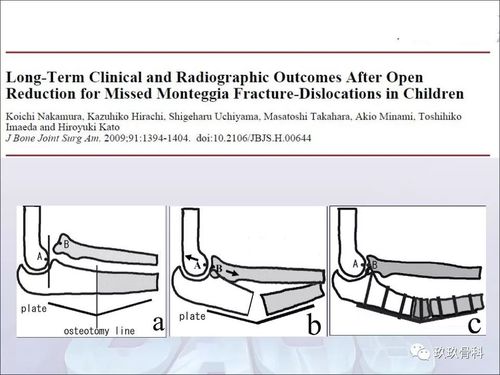儿童陈旧孟氏骨折治疗