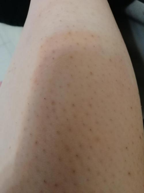 这种毛囊炎或者鸡皮肤有办法去除吗?