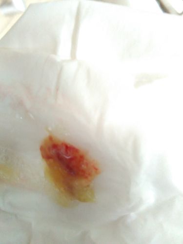 医生您好,我肺结核好了半年,最近喉咙痛,声音沙哑,讲不到话,刚咳出了