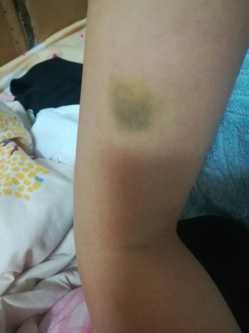 睡觉醒来胳膊紫