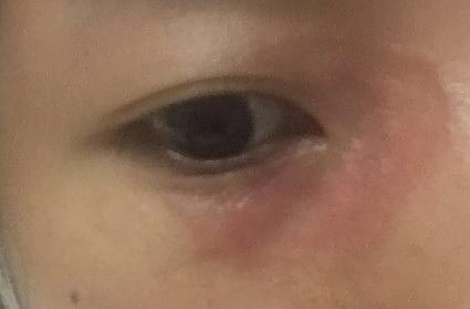 神经性皮炎长在眼周 快毁容了,求救.(有图慎.