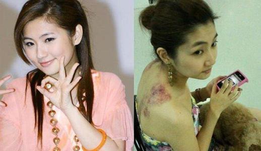 任家萱谈及烧伤哽咽难言她的勇敢是没有选择性的