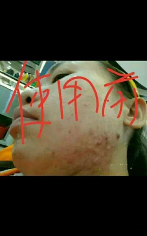 飞蛇,婴幼儿湿疹,红屁股,蚊虫叮,咬,痔疮,脚癣,香港脚等各种皮肤病.无