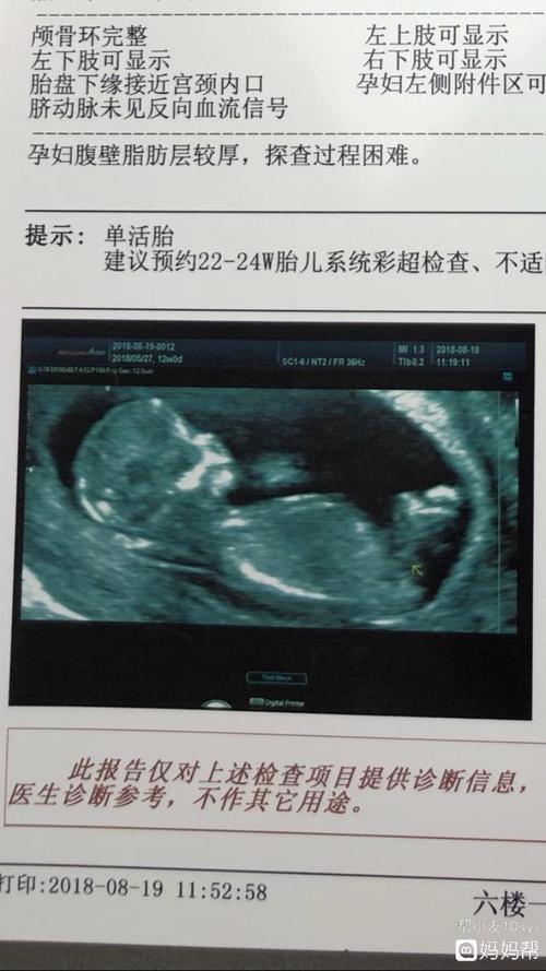 三个月nt的b超图片 有会看的宝妈 看的