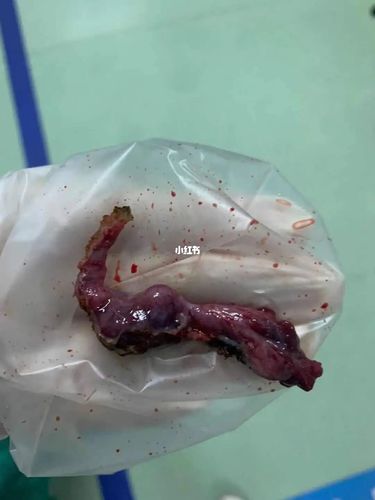 介意勿进哦 右输卵管切除_输卵管_宫外孕_备孕_母婴