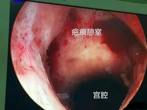 正确认识剖腹产的好处,也要了解剖宫产可能对妈妈的