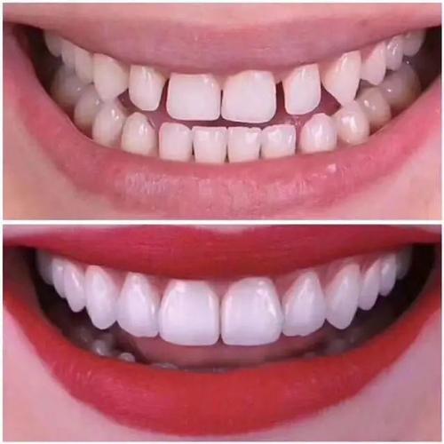 牙贴面 | 极具性价比的美牙"神器"