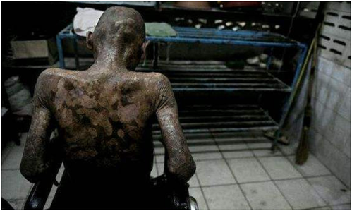 艾滋病图片和照片