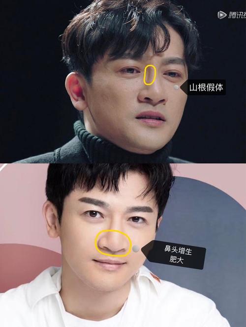 惊!苏有朋的鼻子怎么变成了这样